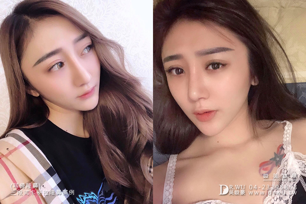 【卡麥拉三段式隆鼻=卡麥拉鼻模+耳軟骨+鼻中隔延長】高挺美鼻的誕生,調整鼻頭角度是大重點!|峻美診所
