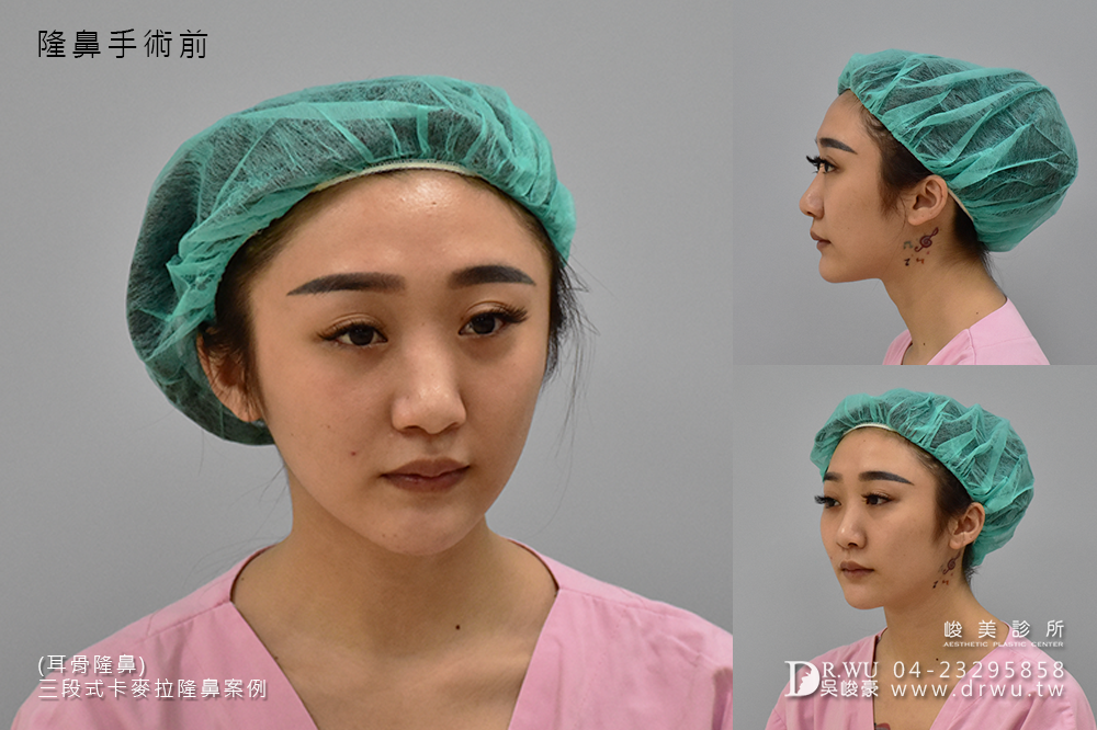 【卡麥拉三段式隆鼻=卡麥拉鼻模+耳軟骨+鼻中隔延長】高挺美鼻的誕生,調整鼻頭角度是大重點!|峻美診所