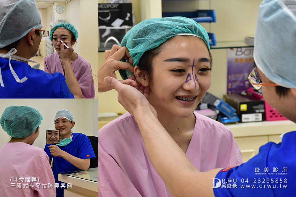 【卡麥拉三段式隆鼻=卡麥拉鼻模+耳軟骨+鼻中隔延長】高挺美鼻的誕生,調整鼻頭角度是大重點!|峻美診所
