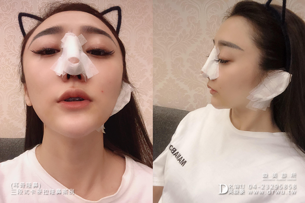 【卡麥拉三段式隆鼻=卡麥拉鼻模+耳軟骨+鼻中隔延長】高挺美鼻的誕生,調整鼻頭角度是大重點!|峻美診所