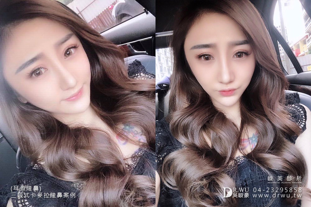 【卡麥拉三段式隆鼻=卡麥拉鼻模+耳軟骨+鼻中隔延長】高挺美鼻的誕生,調整鼻頭角度是大重點!|峻美診所