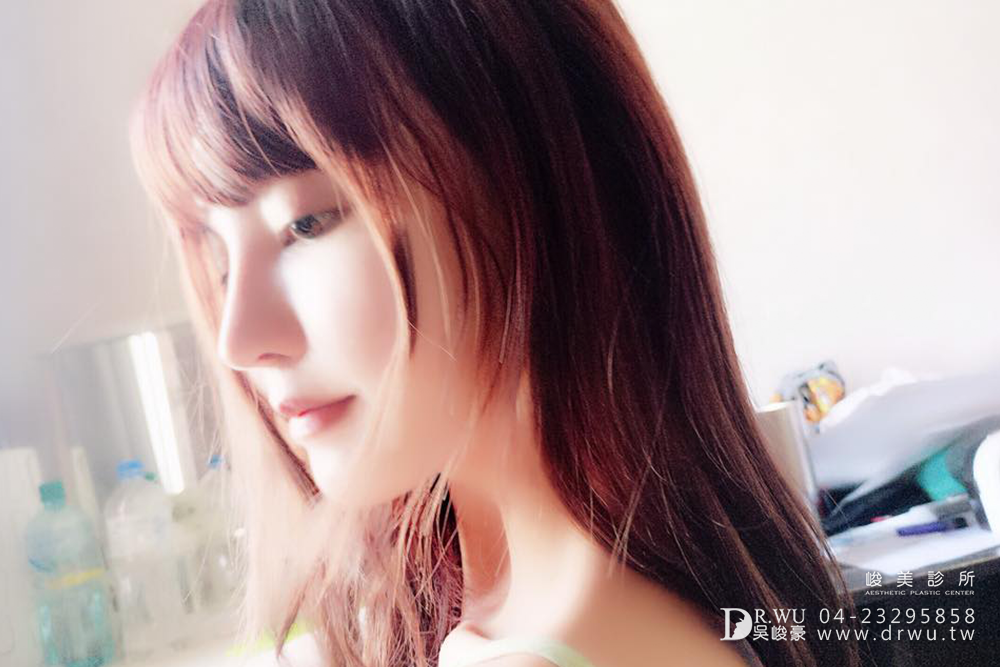 "三段式隆鼻"再次重修我的失敗隆鼻,讓我重拾自信心、勇敢愛自己!!