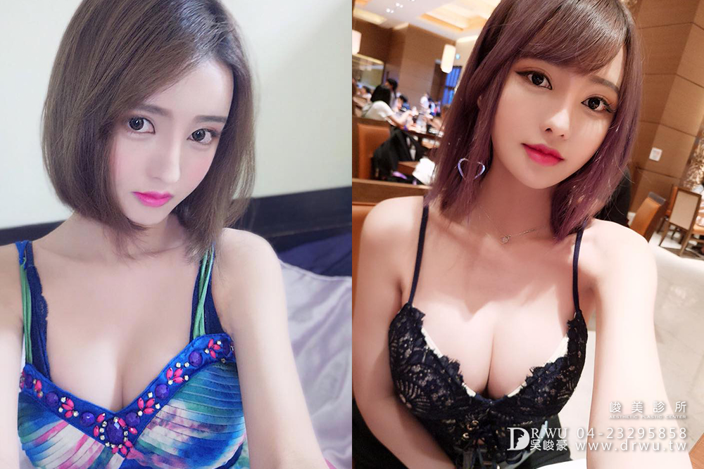 "三段式隆鼻"再次重修我的失敗隆鼻,讓我重拾自信心、勇敢愛自己!!