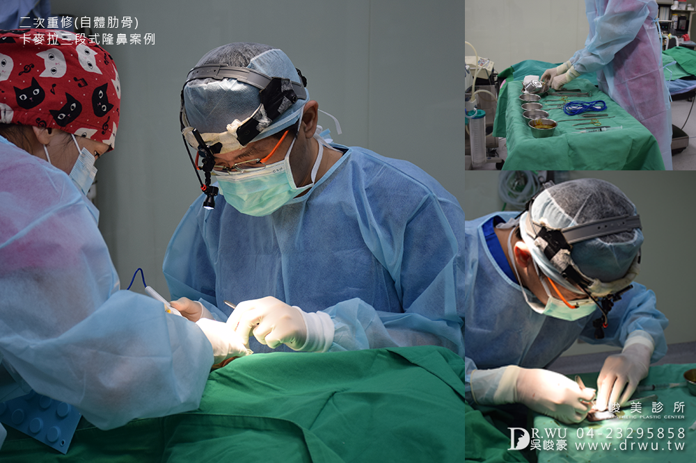 "三段式隆鼻"再次重修我的失敗隆鼻,讓我重拾自信心、勇敢愛自己!!