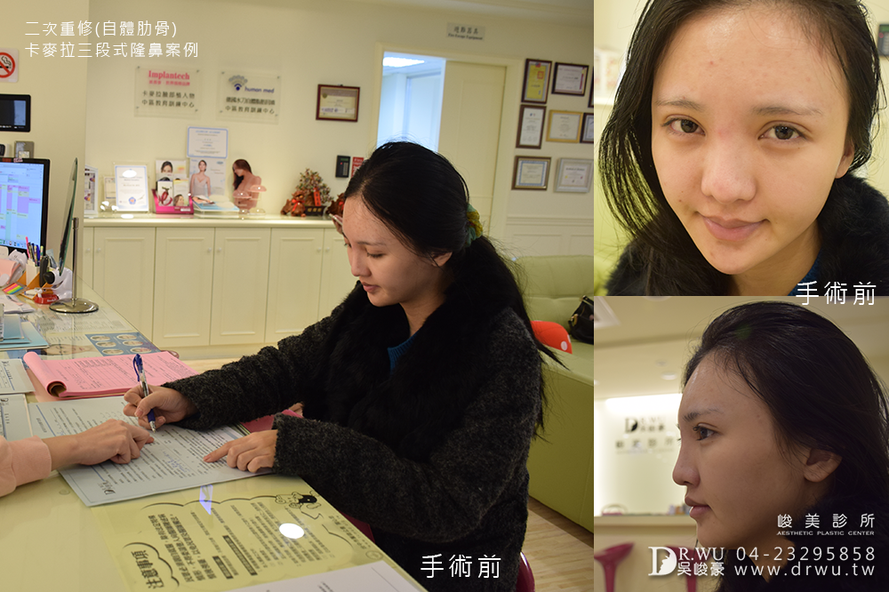 "三段式隆鼻"再次重修我的失敗隆鼻,讓我重拾自信心、勇敢愛自己!!