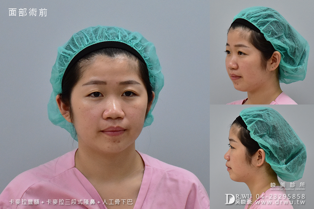 【面部整形】女神感的三種手術一次完成|卡麥拉豐額+卡麥拉三段式隆鼻+人工骨墊下巴|峻美診所