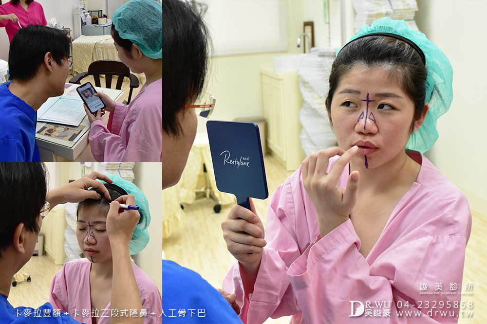 【面部整形】女神感的三種手術一次完成|卡麥拉豐額+卡麥拉三段式隆鼻+人工骨墊下巴|峻美診所
