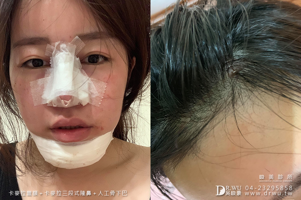 【面部整形】女神感的三種手術一次完成|卡麥拉豐額+卡麥拉三段式隆鼻+人工骨墊下巴|峻美診所