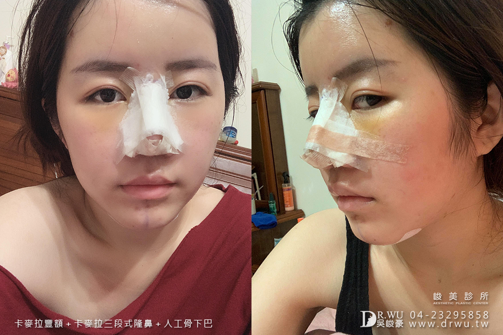 【面部整形】女神感的三種手術一次完成|卡麥拉豐額+卡麥拉三段式隆鼻+人工骨墊下巴|峻美診所