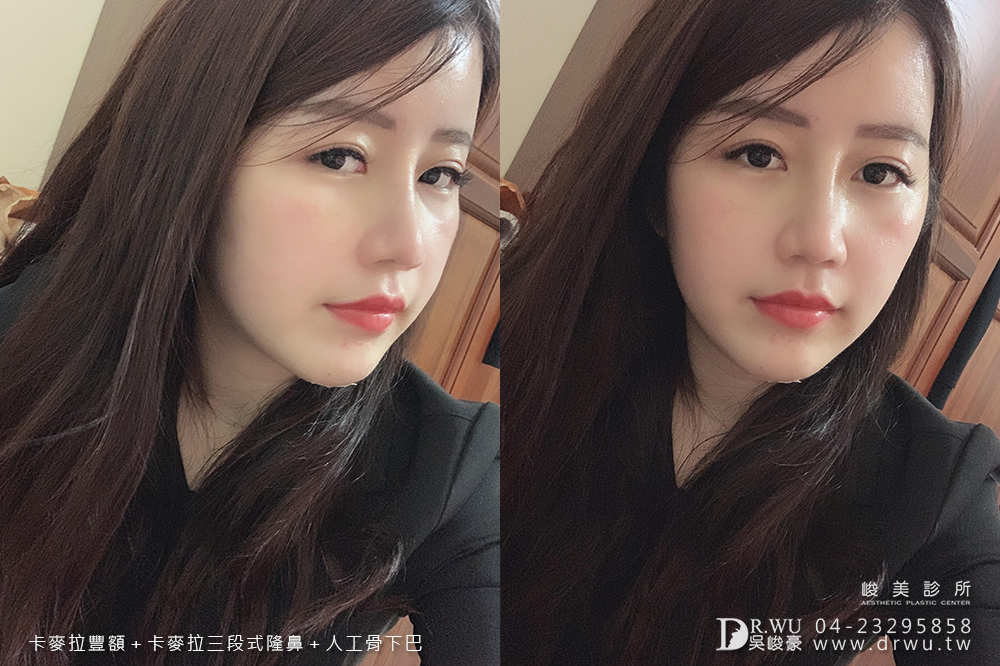 【面部整形】女神感的三種手術一次完成|卡麥拉豐額+卡麥拉三段式隆鼻+人工骨墊下巴|峻美診所