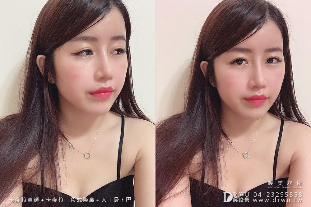 【面部整形】女神感的三種手術一次完成|卡麥拉豐額+卡麥拉三段式隆鼻+人工骨墊下巴|峻美診所