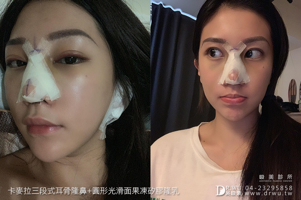 【新一代峻美女神】有一種整形之美,叫做質感美|卡麥拉三段式耳骨隆鼻+圓形光滑面果凍矽膠隆乳|峻美診所