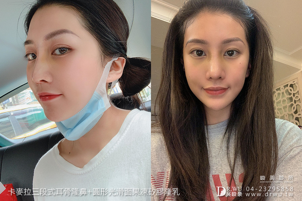 【新一代峻美女神】有一種整形之美,叫做質感美|卡麥拉三段式耳骨隆鼻+圓形光滑面果凍矽膠隆乳|峻美診所