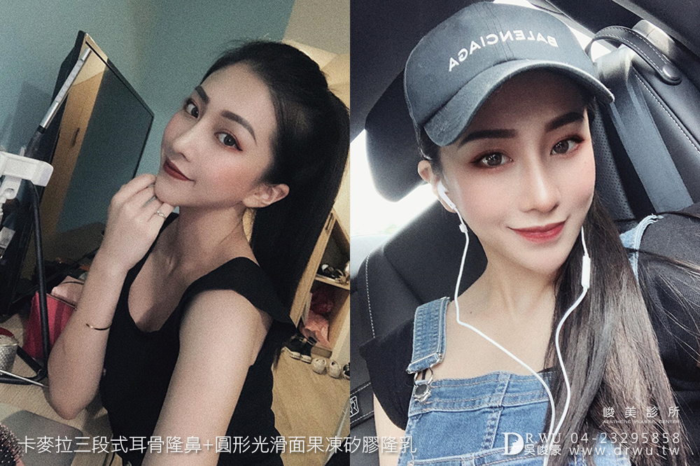 【新一代峻美女神】有一種整形之美,叫做質感美|卡麥拉三段式耳骨隆鼻+圓形光滑面果凍矽膠隆乳|峻美診所