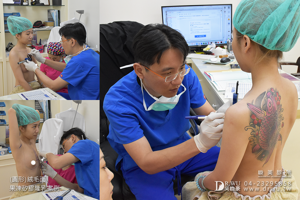 【圓形絨毛面果凍矽膠隆乳手術】產後隆乳免按摩。360度美胸無死角|峻美診所
