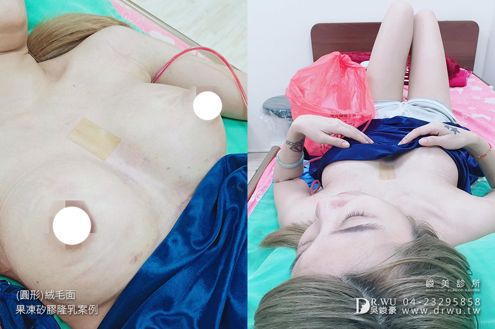 【圓形絨毛面果凍矽膠隆乳手術】產後隆乳免按摩。360度美胸無死角|峻美診所