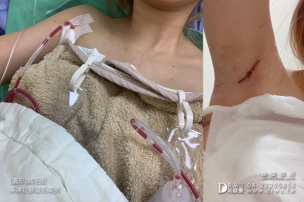 【圓形絨毛面果凍矽膠隆乳手術】產後隆乳免按摩。360度美胸無死角|峻美診所