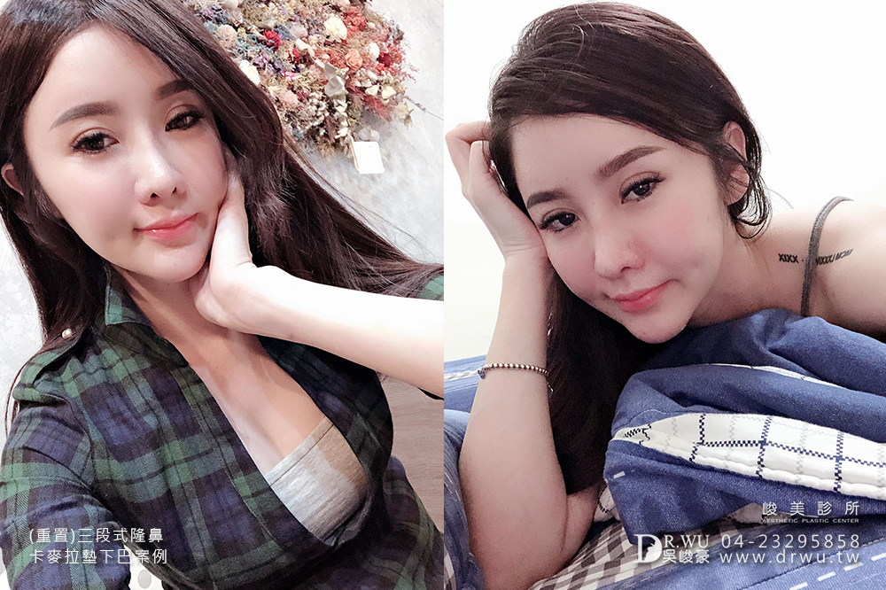 【重置隆鼻】隆鼻重做交給峻美,二次隆鼻後更完美!|三段式卡麥拉隆鼻手術+卡麥拉下巴|峻美診所