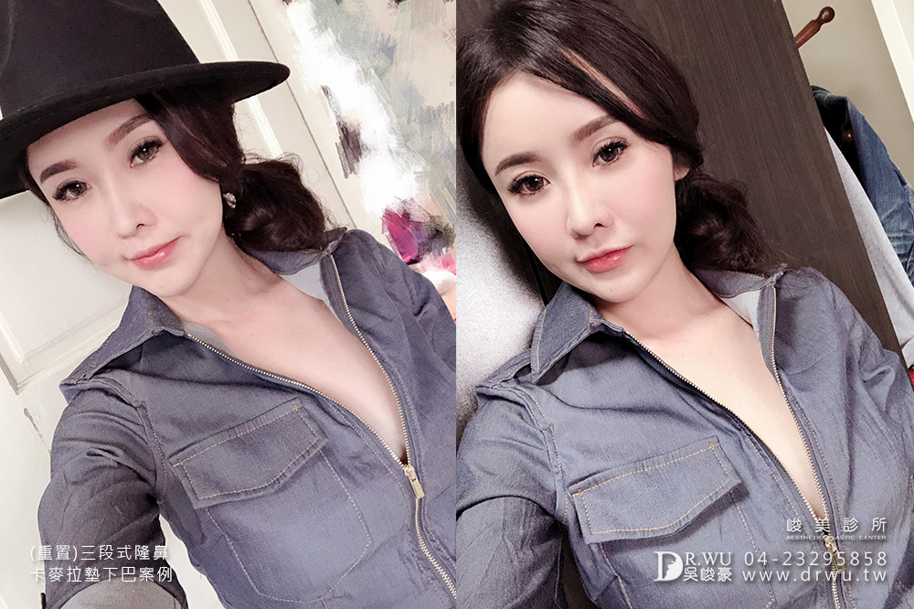 【重置隆鼻】隆鼻重做交給峻美,二次隆鼻後更完美!|三段式卡麥拉隆鼻手術+卡麥拉下巴|峻美診所