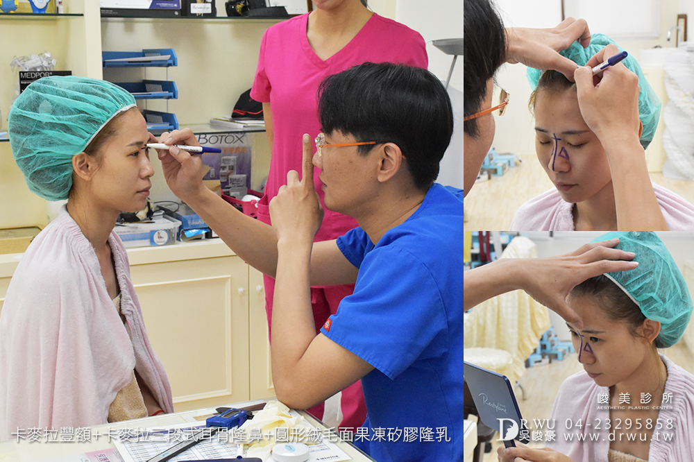 【額鼻胸】整形出屬於個人化風格的美|卡麥拉豐額+卡麥拉隆鼻+果凍矽膠隆乳手術|峻美診所