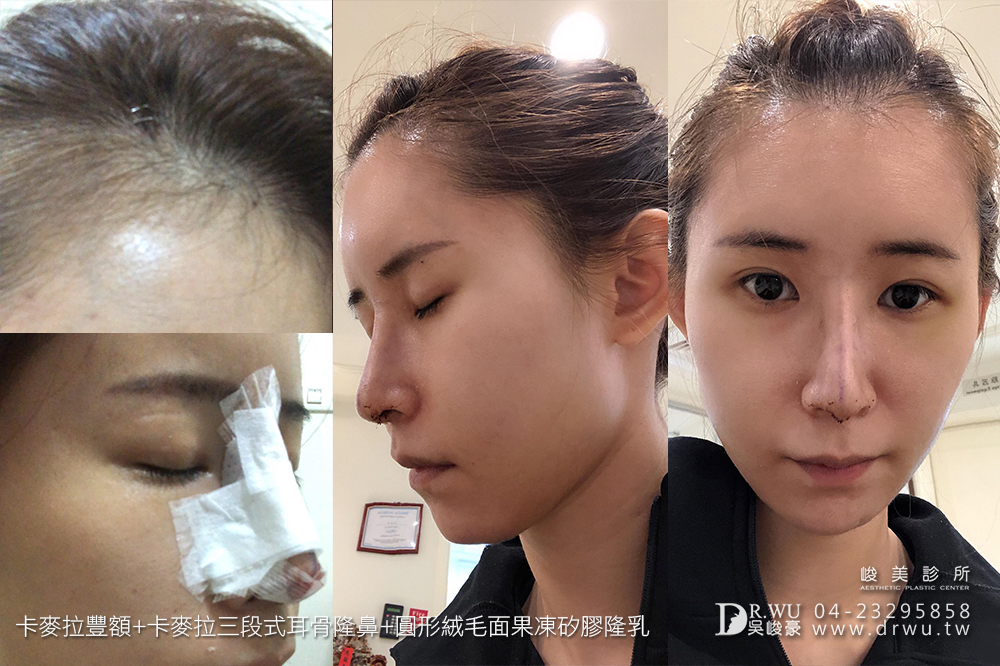 【額鼻胸】整形出屬於個人化風格的美|卡麥拉豐額+卡麥拉隆鼻+果凍矽膠隆乳手術|峻美診所