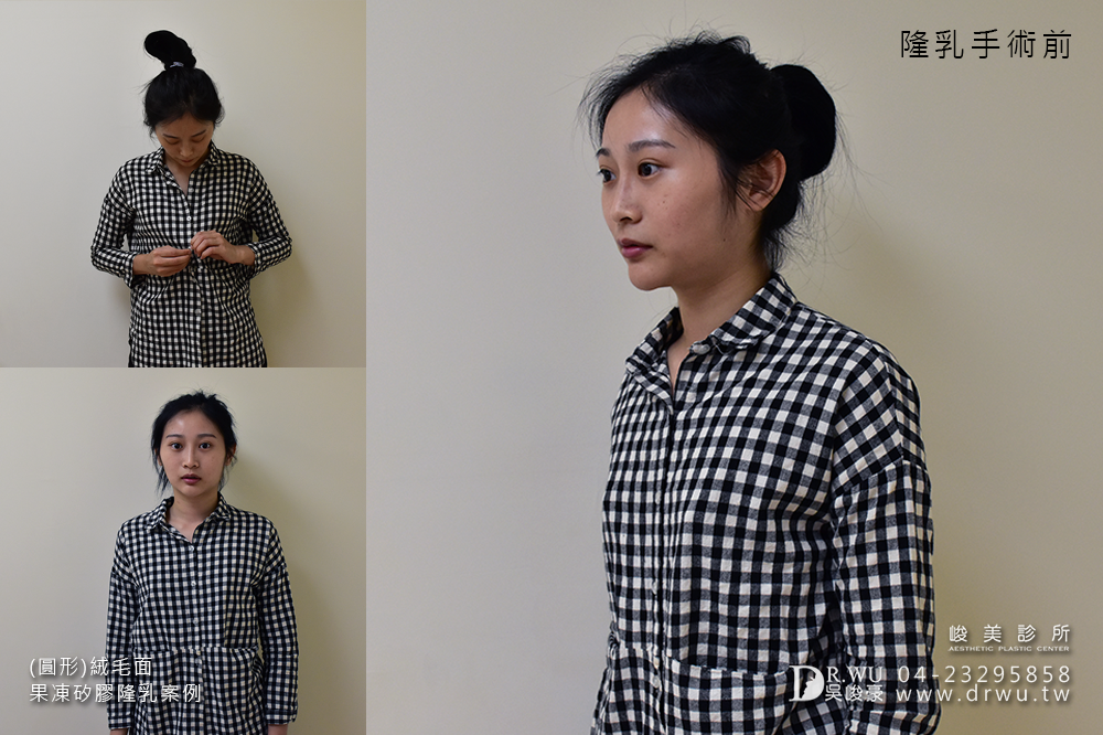 【隆乳案例】加厚型調整型內衣通通丟掉,美美的胸型免按摩~|台中隆乳手術|峻美診所