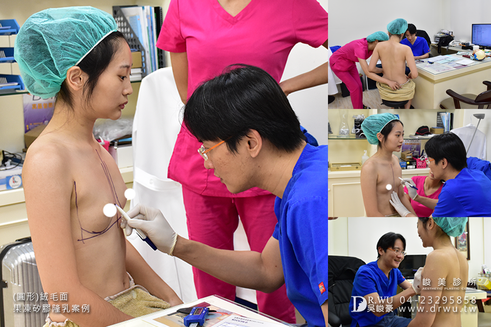 【隆乳案例】加厚型調整型內衣通通丟掉,美美的胸型免按摩~|台中隆乳手術|峻美診所