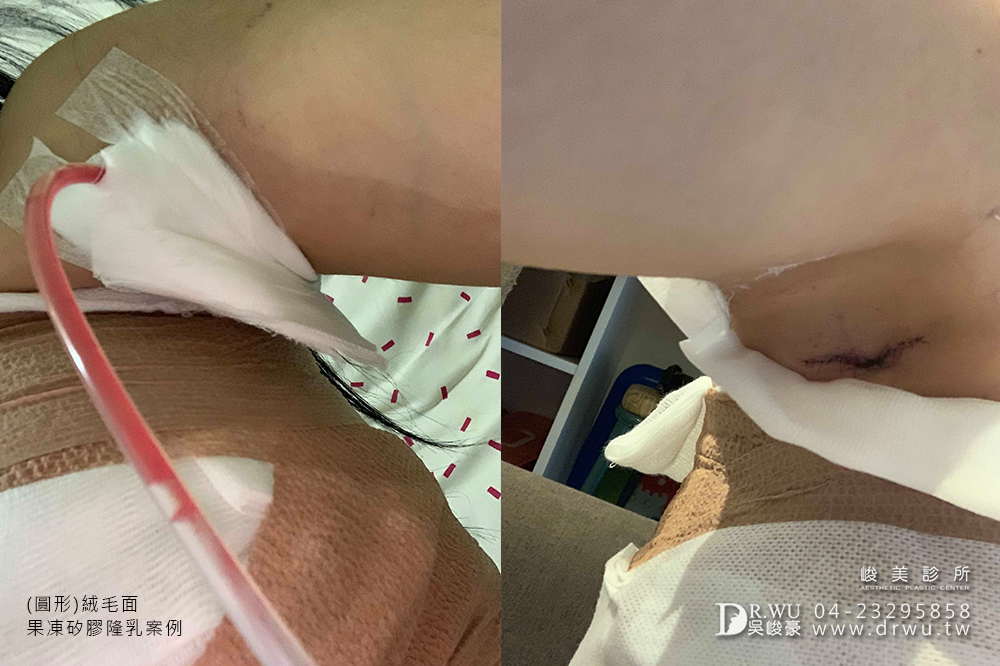 【隆乳案例】加厚型調整型內衣通通丟掉,美美的胸型免按摩~|台中隆乳手術|峻美診所
