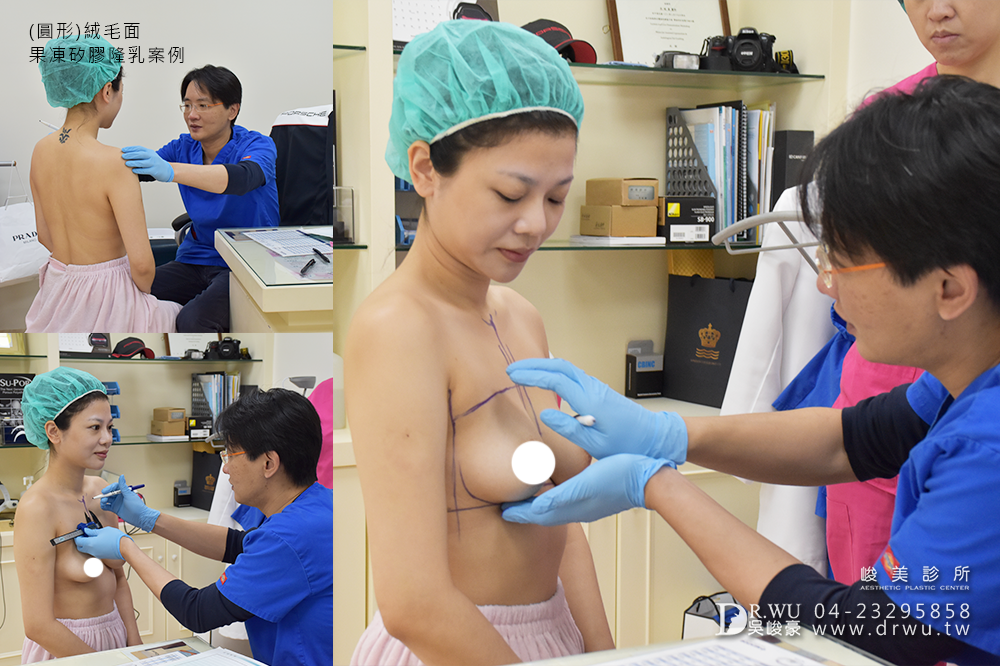 【隆乳案例】美胸女神,隆乳手術過程分享|圓形絨毛面果凍矽膠隆乳|峻美診所