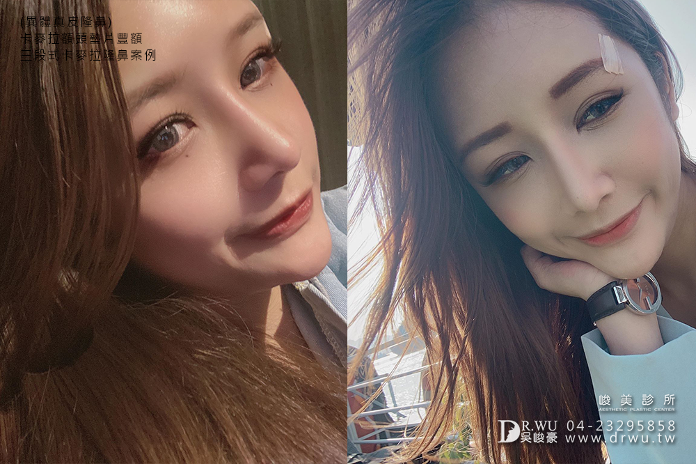 【異體真皮隆鼻】洋娃娃般的隆鼻不用擔心感染,穿出|卡麥拉豐額、卡麥拉三段式隆鼻|峻美診所