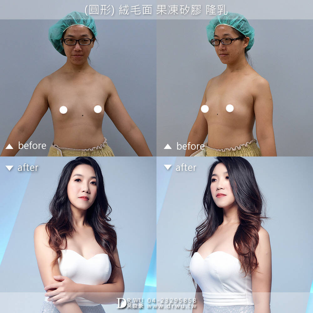 【台中隆乳。實績經驗強大。胸之國度】 #隆乳 #峻美診所 #吳峻豪醫師 #隆乳案例
