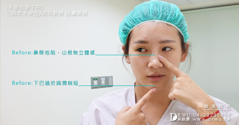 三段式隆鼻利用耳軟骨及卡麥拉隆鼻材質|隆鼻|下巴|吳峻豪醫師|峻美診所