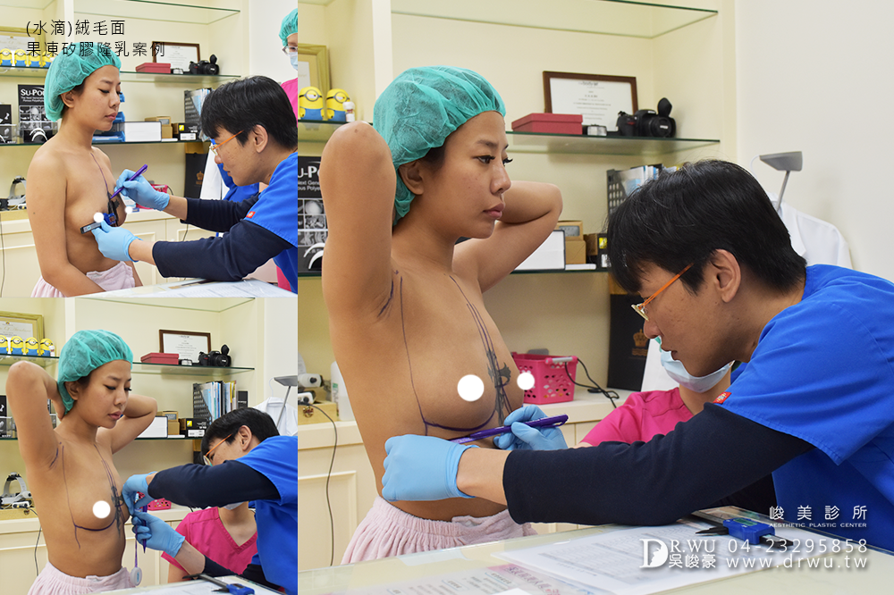 【Mentor曼陀隆乳】水滴型義乳,打造美人魚般的自然豐滿|水滴絨毛面果凍矽膠隆乳|峻美診所