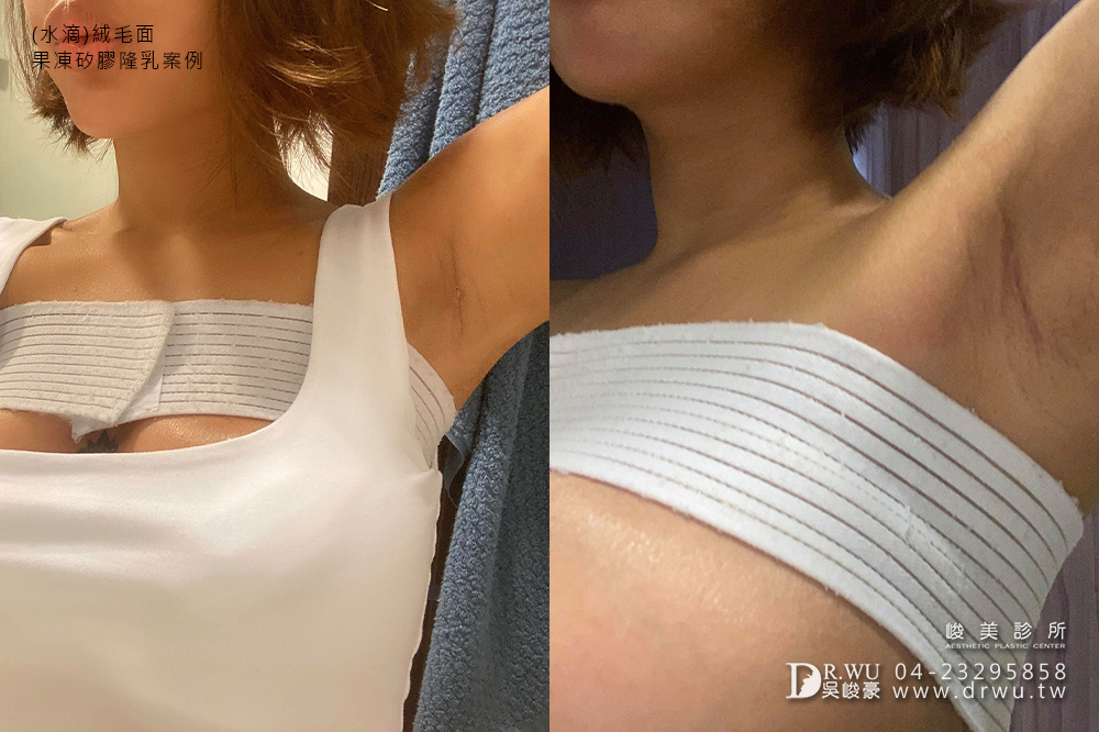 【Mentor曼陀隆乳】水滴型義乳,打造美人魚般的自然豐滿|水滴絨毛面果凍矽膠隆乳|峻美診所