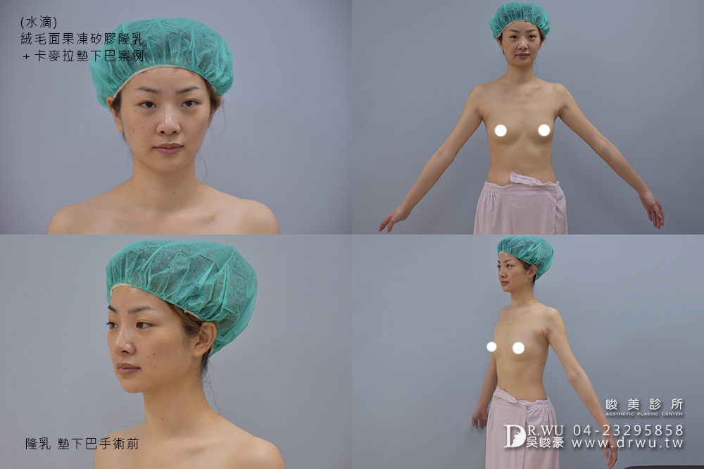 【Mentor曼陀隆乳】如同水滴形狀般的美胸,免按摩保養超便利!|水滴內視鏡果凍矽膠隆乳手術|