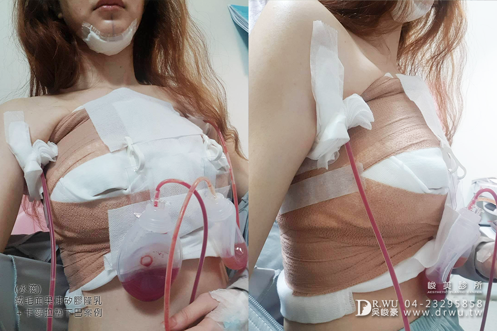 【Mentor曼陀隆乳】如同水滴形狀般的美胸,免按摩保養超便利!|水滴內視鏡果凍矽膠隆乳手術|