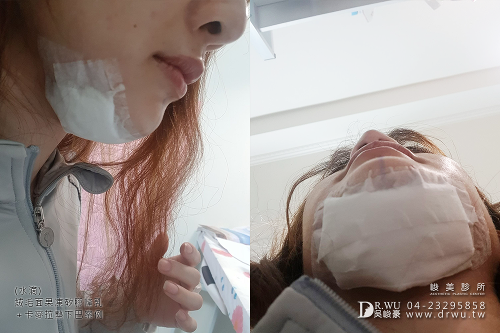 【Mentor曼陀隆乳】如同水滴形狀般的美胸,免按摩保養超便利!|水滴內視鏡果凍矽膠隆乳手術|