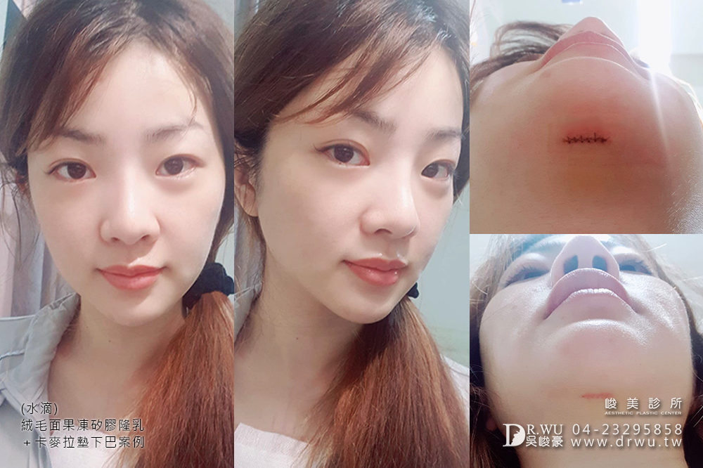 【Mentor曼陀隆乳】如同水滴形狀般的美胸,免按摩保養超便利!|水滴內視鏡果凍矽膠隆乳手術|