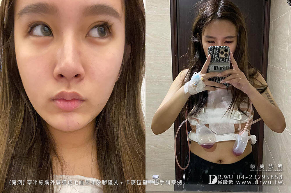 【魔滴女神】輕鬆獲得夢想中的自然美胸~Motiva波力媚隆乳|內視鏡果凍矽膠隆乳手術|