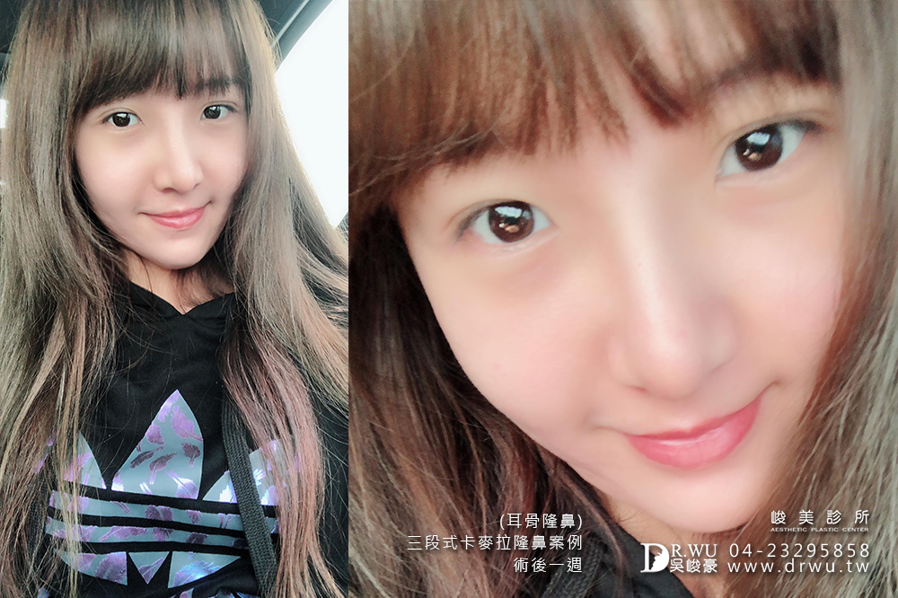 【三段式耳骨隆鼻】醫師吳峻豪隆鼻超高技術,卡麥拉隆鼻恢復期免擔心|峻美診所
