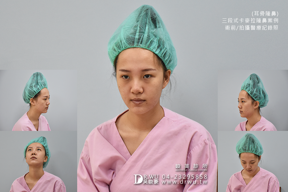 【三段式耳骨隆鼻】醫師吳峻豪隆鼻超高技術,卡麥拉隆鼻恢復期免擔心|峻美診所