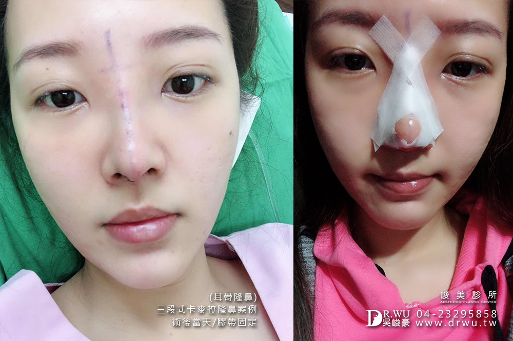 【三段式耳骨隆鼻】醫師吳峻豪隆鼻超高技術,卡麥拉隆鼻恢復期免擔心|峻美診所