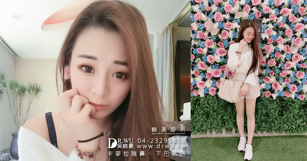 【三段式卡麥拉隆鼻】醫師吳峻豪隆鼻後,讓我零修圖臻美麗|人工骨墊下巴|峻美診所
