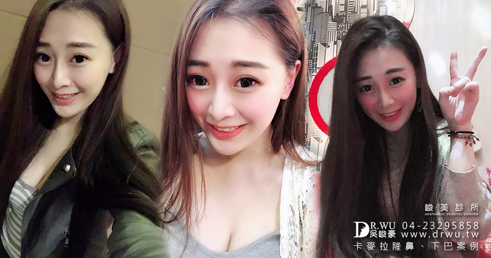 【三段式卡麥拉隆鼻】醫師吳峻豪隆鼻後,讓我零修圖臻美麗|人工骨墊下巴|峻美診所