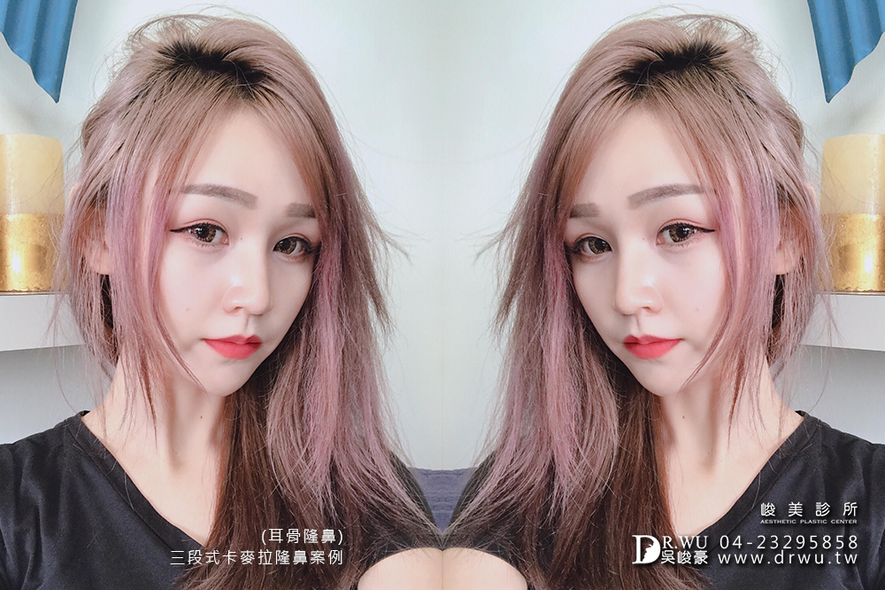 【耳軟骨+三段式卡麥拉隆鼻】網路一致推薦台中隆鼻-吳峻豪醫師超強!!
