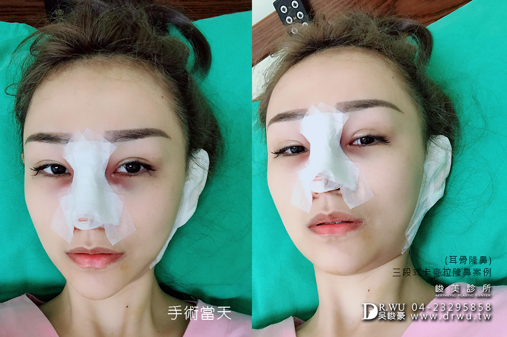【耳軟骨+三段式卡麥拉隆鼻】網路一致推薦台中隆鼻-吳峻豪醫師超強!!