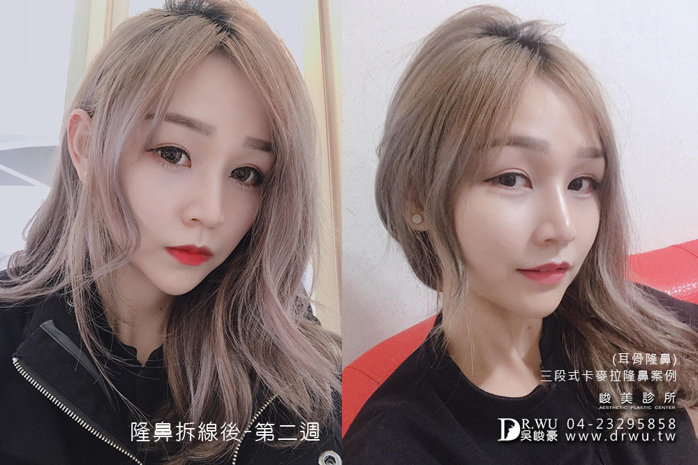 【耳軟骨+三段式卡麥拉隆鼻】網路一致推薦台中隆鼻-吳峻豪醫師超強!!