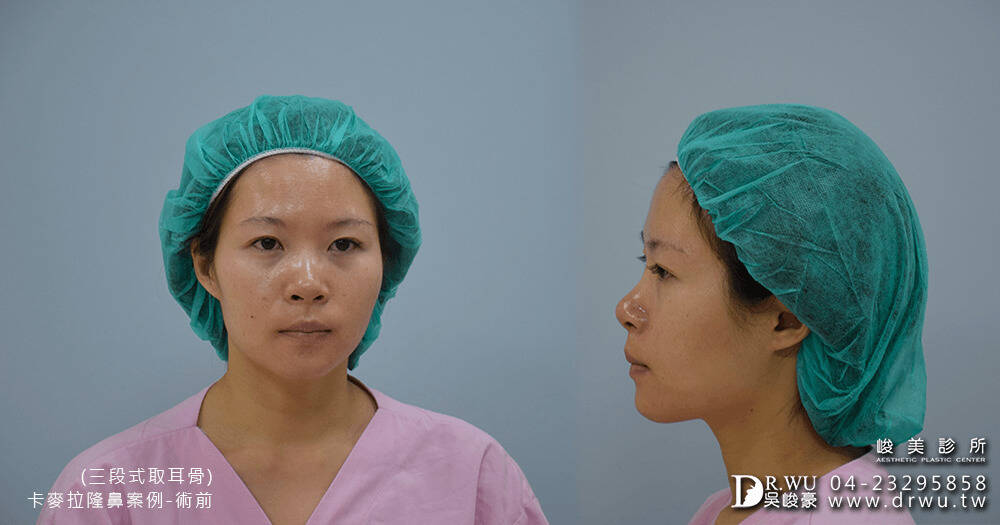 進行卡麥拉三段式隆鼻術前拍攝│卡麥拉三段式隆鼻手術前