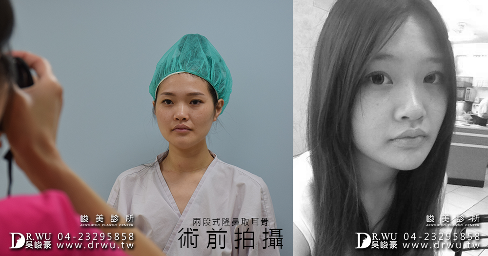 兩段式隆鼻取耳骨|精緻型美鼻很簡單|雨兒女神見證