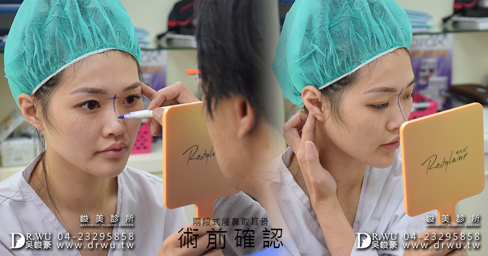 兩段式隆鼻取耳骨|精緻型美鼻很簡單|雨兒女神見證
